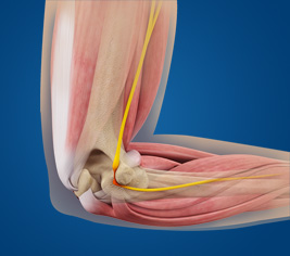 Cubital Tunnel Syndrome