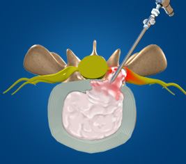 Microdiscectomy