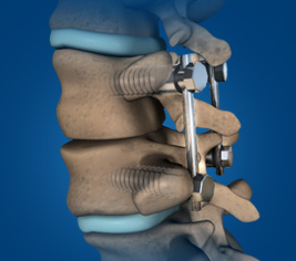 Spinal Fusion