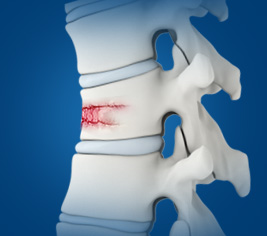 Spine Trauma