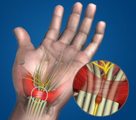 Carpal Tunnel Syndrome